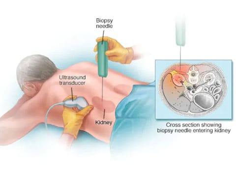 Kidney doctor in Singampunari
